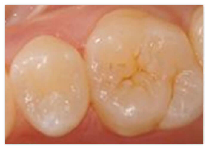 マイクロスコープを用いた虫歯治療４